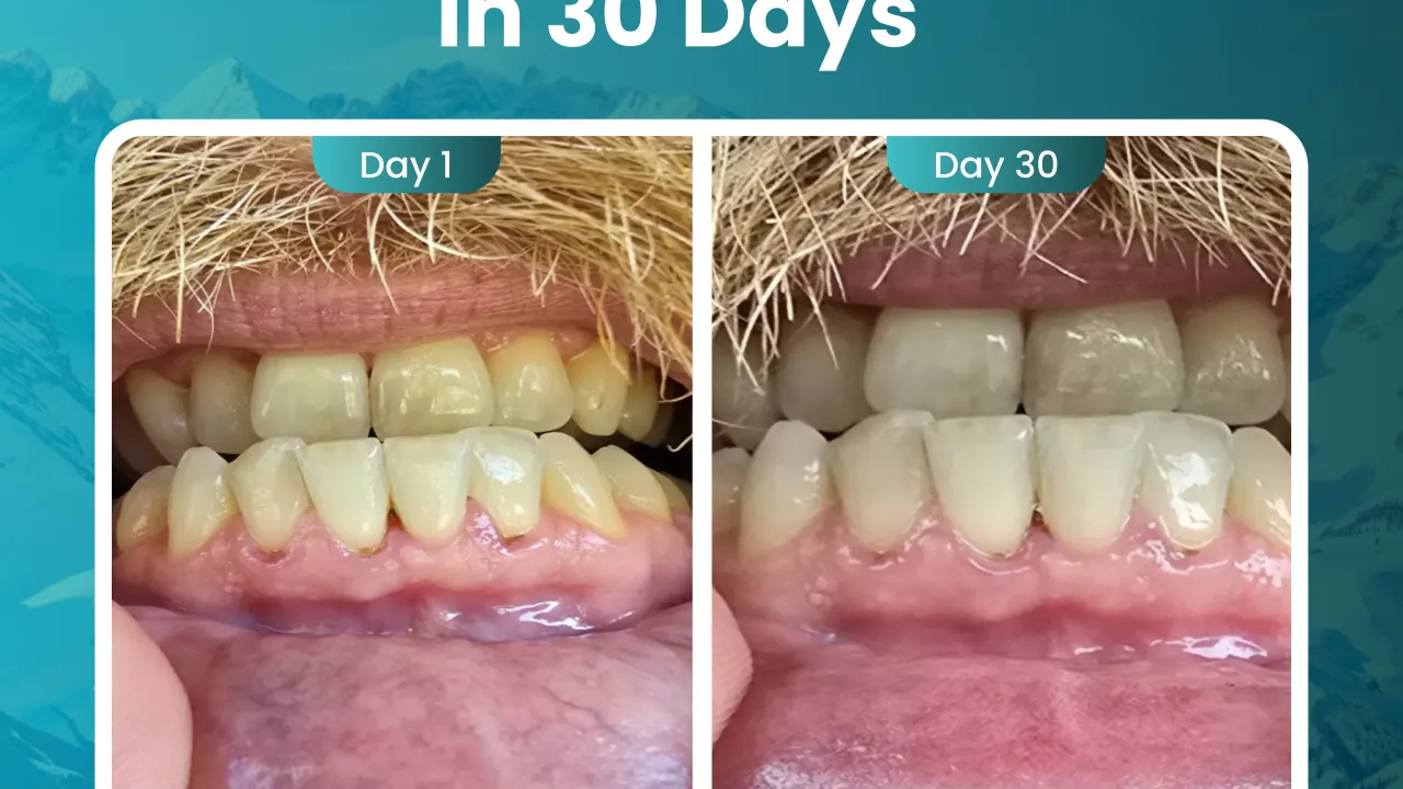 The "Healthy Gum" Trend is a Scam—Here’s How to Profit From It